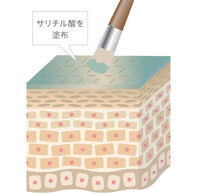 サリチル酸を塗布